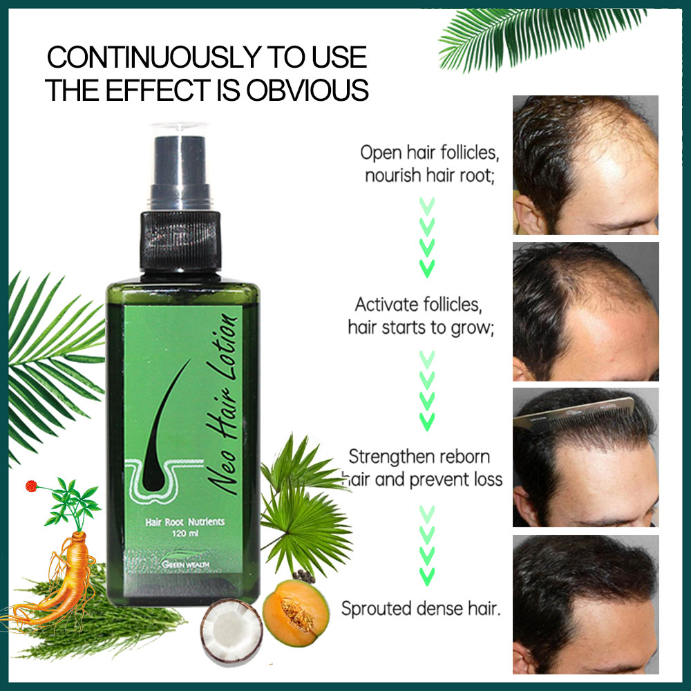 4 szt. Neo Hair Lotion 120ml P – Nutrition And Fitness recenzja i cena
